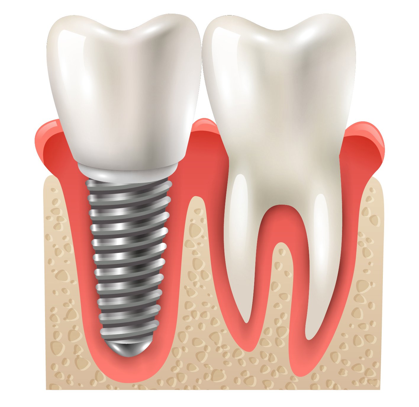 Invisalign in Jaipur