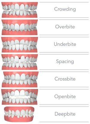 Rai Dental Hospital Invisalign In Jaipur